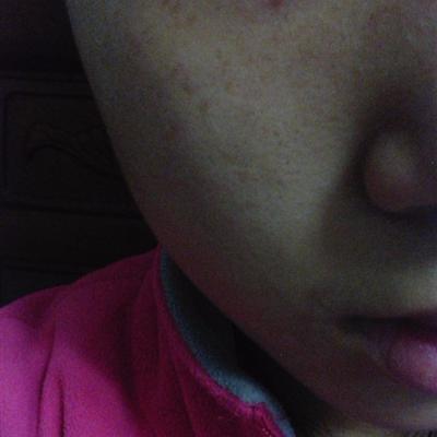 Where is the best hospital for freckle removal