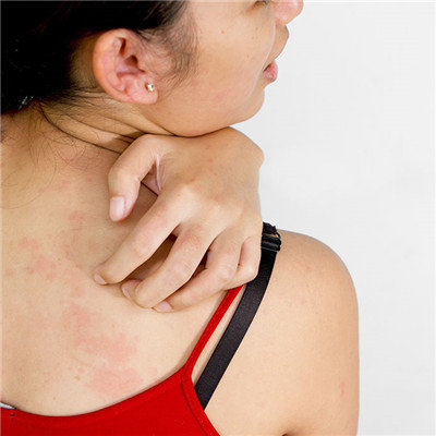 How to treat pityriasis rosea?