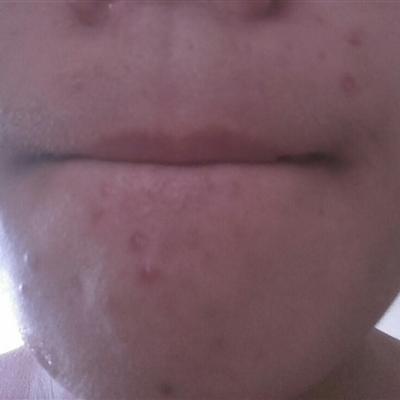 How does the close sex acne on the face remove