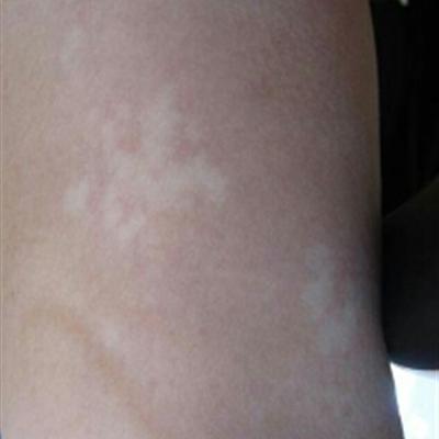 What reason does crus have small white piece