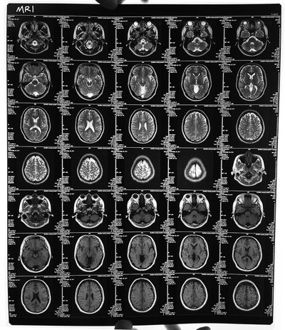 Is Chinese medicine good for epilepsy patients?