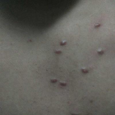 What symptom is adult whole body long varicella