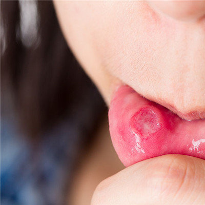 What reason is often angular herpes?