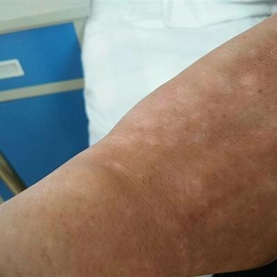 What complications do psoriasis patients have