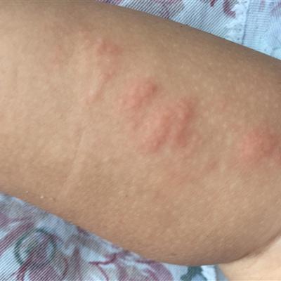 How can scabies be treated thoroughly?