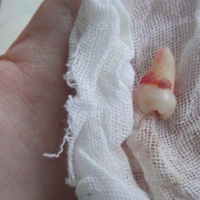 The harm of wisdom teeth