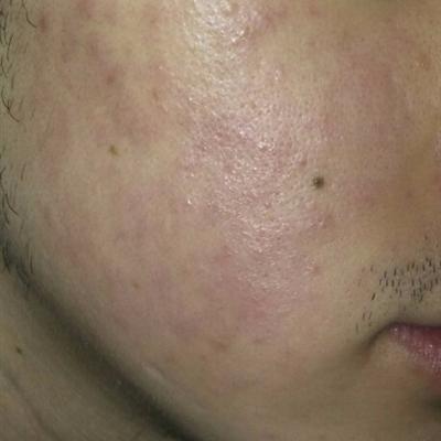 How to remove acne print effect is good