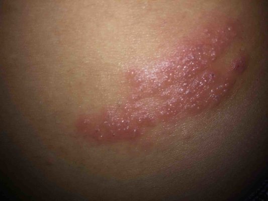 Symptoms of viral herpes