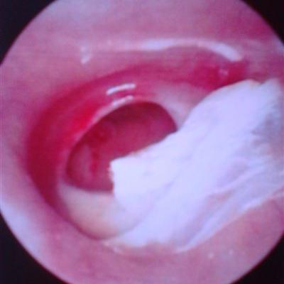 How to cure otitis media