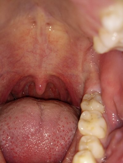 What symptom is there white dot on tonsil?