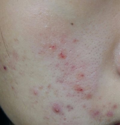 Symptoms of scar acne