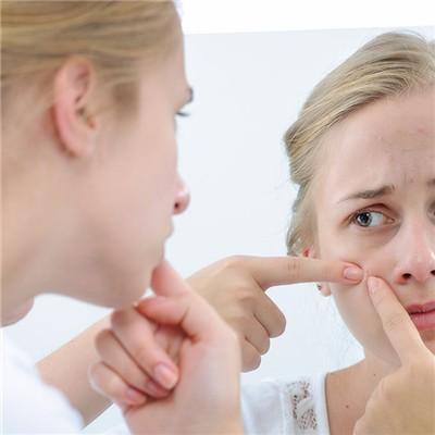 What is the cause of acne in District t