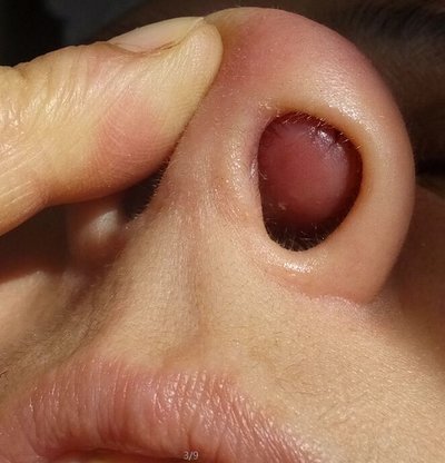 Symptoms of severe nasal polyps